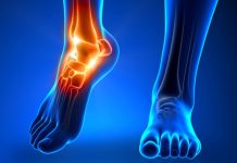 Ученые обнаружили основные причины возникновения подагры