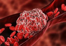 В США создали технологию, позволяющую разрушать тромбы за считанные секунды