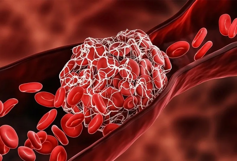 В США создали технологию, позволяющую разрушать тромбы за считанные секунды