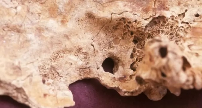 В Римской империи делали сложные операции на головном мозге