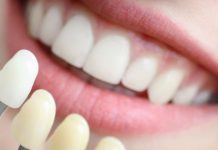 Виниры: красота улыбки и уверенность в себе