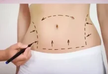 Абдоминопластика живота: кому показана операция и какие проблемы решает