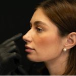 Септопластика носовой перегородки: ход операции и показания