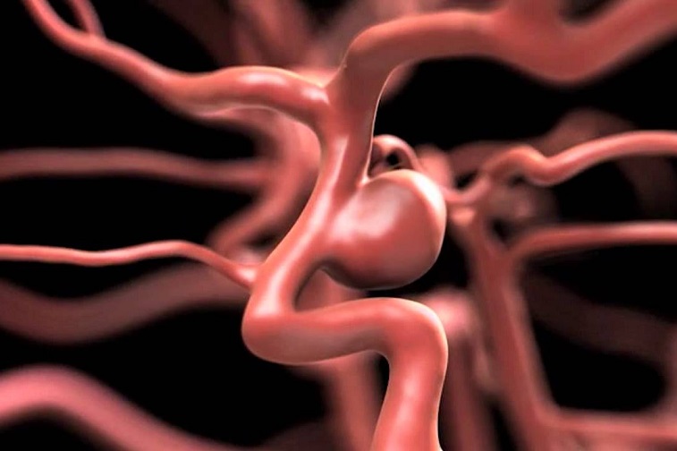 Аневризма: как её распознать и предотвратить разрыв?