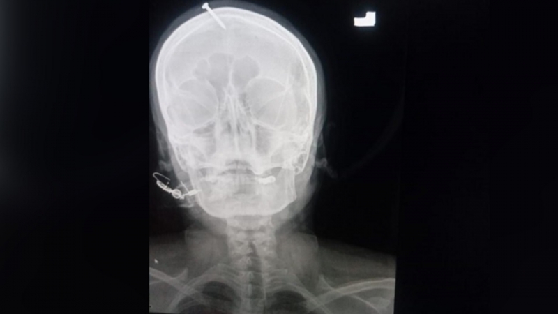 Женщина вбила себе в голову гвоздь, чтобы родить мальчика